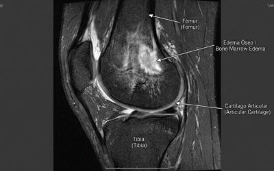 Edema óseo: qué es y cómo te ayuda la fisioterapia