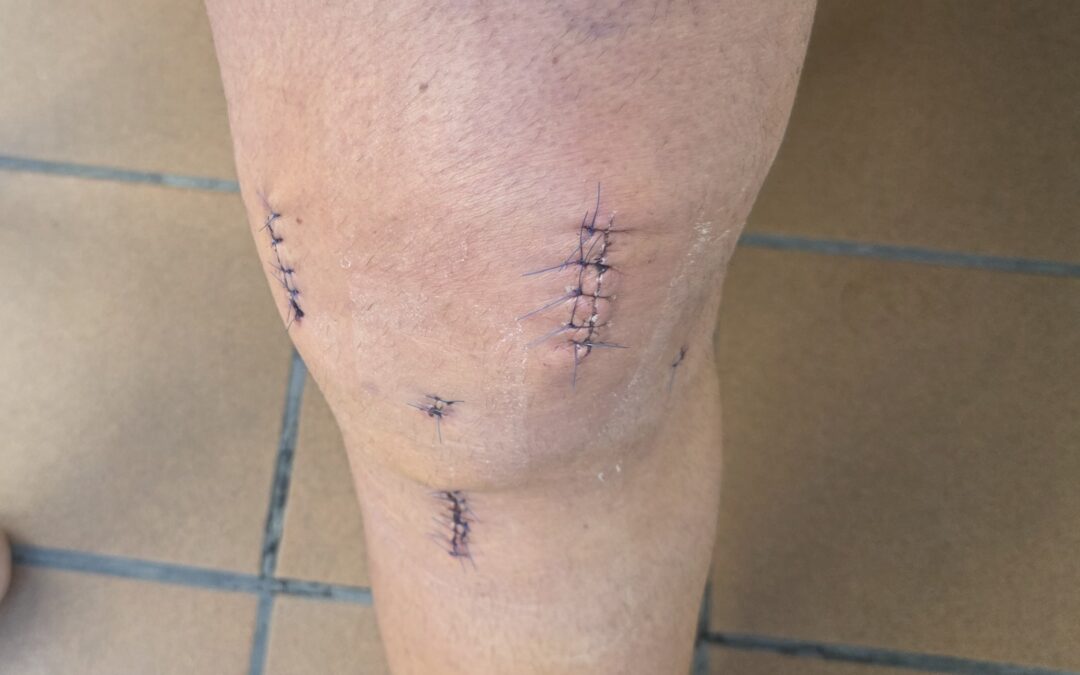 Rodilla tras artroscopia de LCA y LLI